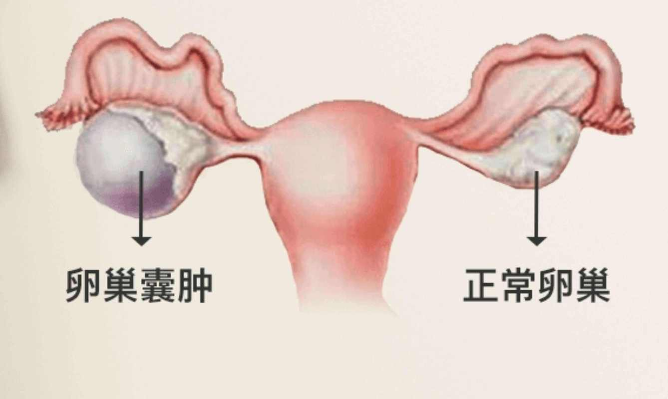 病理性囊肿与试管婴儿：科学应对，生育仍有希望
