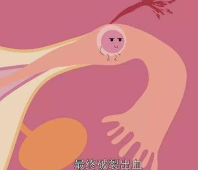佛山试管婴儿移植胚胎该选择一个还是两个