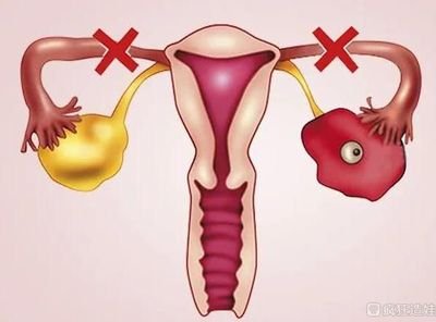 试管婴儿促排卵失败的原因有哪些?如何应对