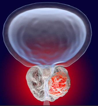 宫颈囊肿多发什么意思,会不会影响试管婴儿的妊娠终局