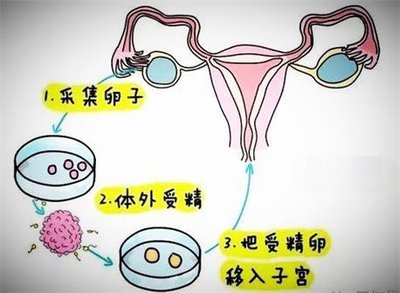 在深圳试管婴儿医治中应该如何选择胚胎移植方式