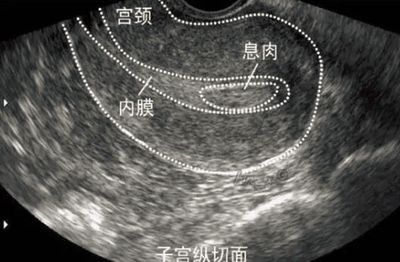 排卵障碍怀不上宝宝怎么办可以试管婴儿医治吗