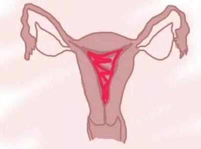 黄体功用不全影响生养能做试管婴儿吗