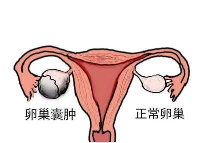 患上巧克力囊肿怀孕艰难可以选择试管婴儿助孕吗