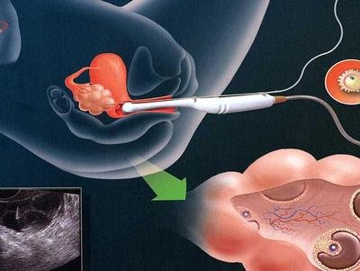中山试管取卵的时间通常是依据什么肯定的