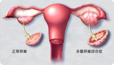 珠海试管婴儿助孕医治中激素针药会诱发肿瘤的出现吗