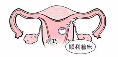 子宫腺肌症不孕几年的女性能中山试管婴儿助孕医治吗