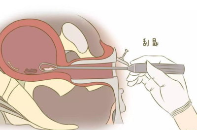 慢性宫颈炎会产生哪些危害对女性怀孕有什么影响吗