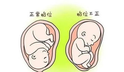 多囊卵巢患者做试管助孕过程中要注意什么